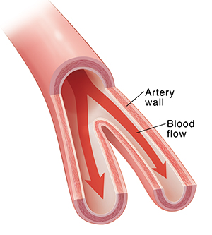 Cross section of artery showing clean artery wall and blood flow.