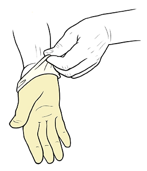 Hand pulling surgical glove on opposite hand.