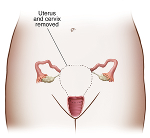 Front view of woman's pelvis showing reproductive tract. Dotted line around uterus and cervix shows organs removed in total hysterectomy.