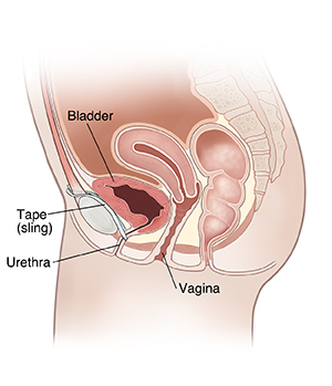 Side view cross section of female pelvis showing midurethral sling.