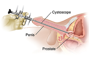 Side view of male pelvis showing transurethral resection of the prostate.