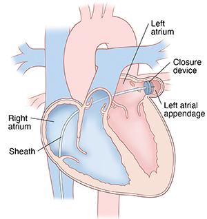 Front view cross section of heart showing catheter inserted through inferior vena cava and across both atria into left atrial appendage. Closure device is at end of catheter in left atrial appendage.