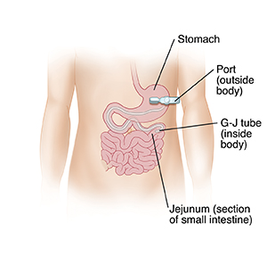 Front view of child's abdomen showing G-J tube inserted through body wall into stomach with tube going into small intestine.