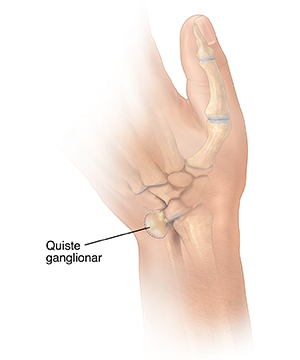 Vista posterior de una mano en la que se ve una línea de puntos alrededor de un quiste ganglionar en la muñeca.