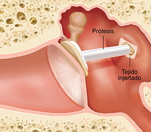 Corte transversal de un oído donde pueden verse las estructuras del oído externo, interno y medio, con prótesis e injerto de tejido.