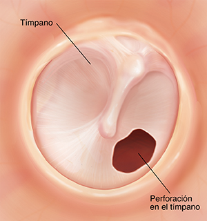 Tímpano con un orificio.