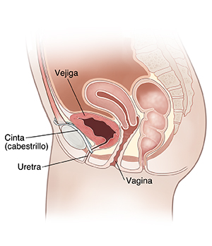 Vista lateral de corte transversal de la pelvis femenina donde se observa el cabestrillo mediouretral.