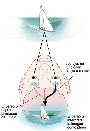 Vista de los ojos y el cerebro desde la parte superior de la cabeza que muestra una visión borrosa en un ojo debido a la ambliopía. Imagen desde el ojo con visión borrosa que no se procesó en el cerebro.