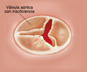 Vista superior de una válvula aórtica cerrada con insuficiencia.