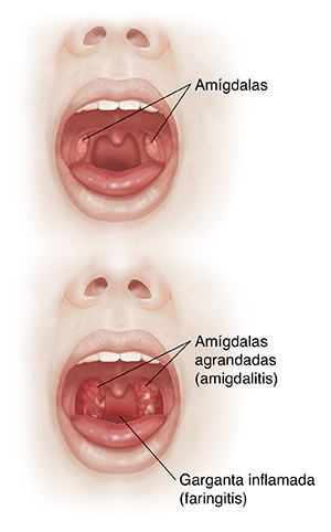 Vista frontal de una cara con la boca abierta donde se compara la cavidad bucal y las amígdalas con una garganta inflamada y amígdalas agrandadas.